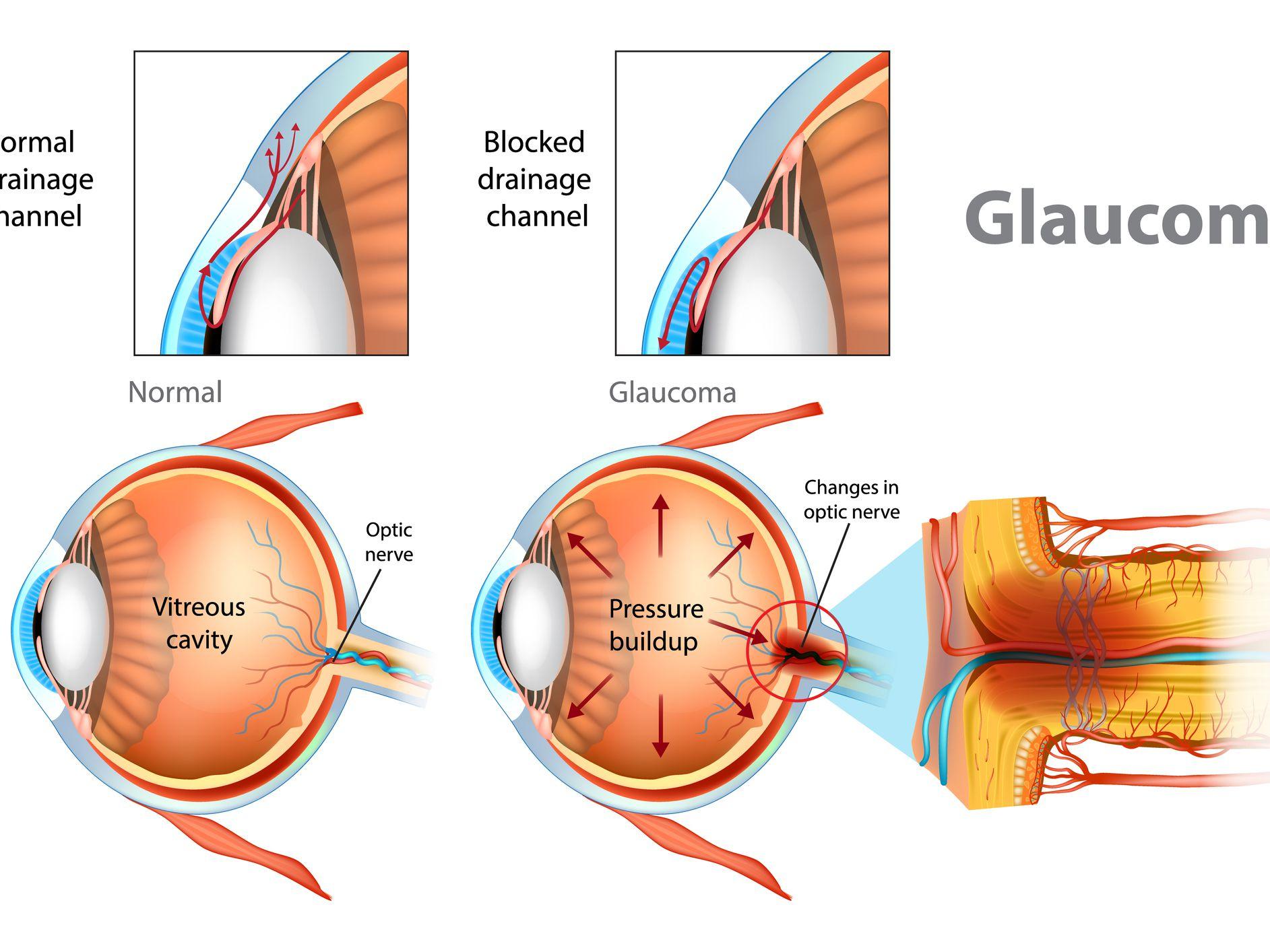 glaucoma specialist