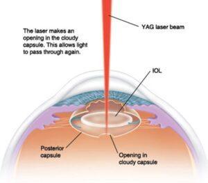 YAG-Capsulotomy-Complications