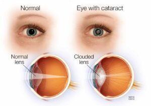 cataract specialist