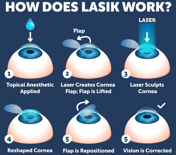 Best Lasik Surgery in Jabalpur