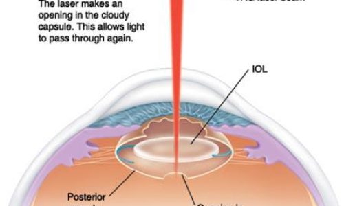 YAG-Capsulotomy-Complications